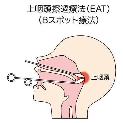痰を吐き出せる後鼻漏があり上咽頭炎でbスポット治療 している