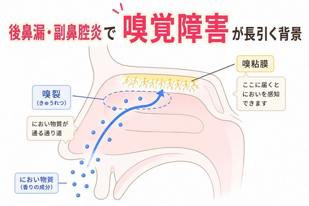 嗅覚障害が後鼻漏・副鼻腔炎で長引く背景｜におい物質が届きにくい状態とは？